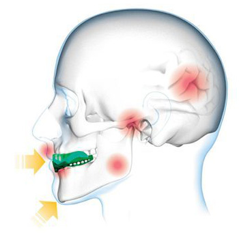 Protege-dents haut de gamme